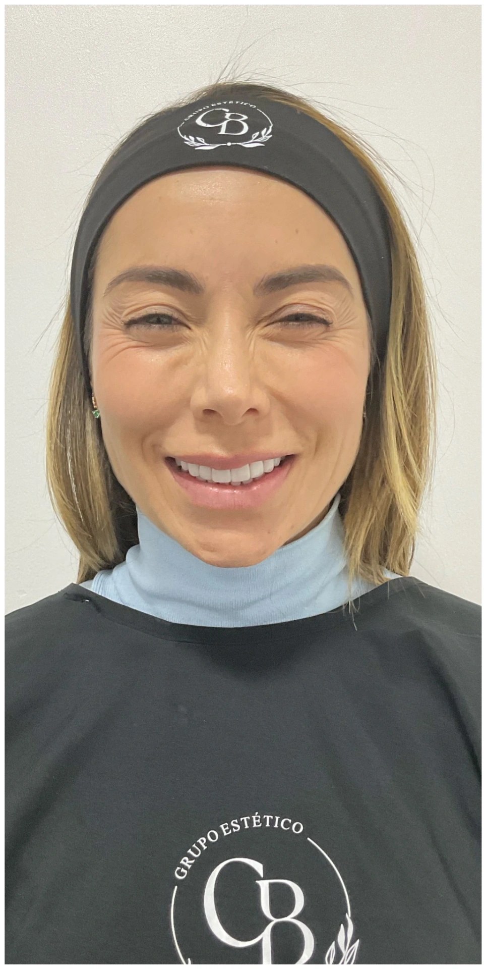 Antes — Botox · Frente y entrecejo